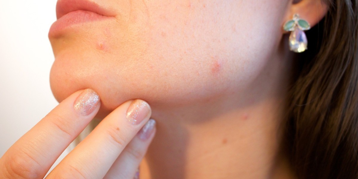 Experience Clear Skin at House of Aesthetics: Professional Acne Treatment in Delhi